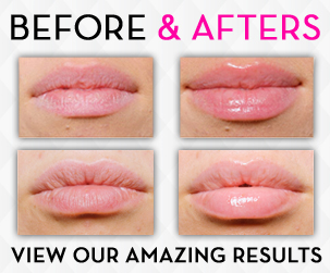 lipsmart-before-after71